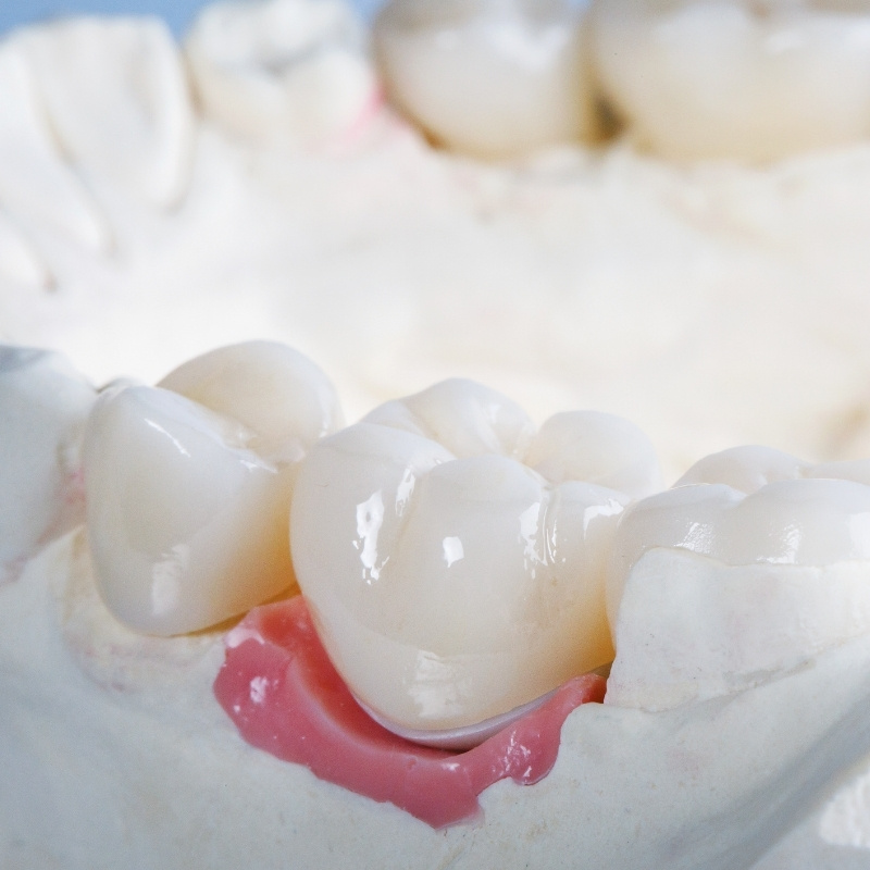 Prothese_Dentaire_Cabinet_Motorpool_Dentiste_Couronne