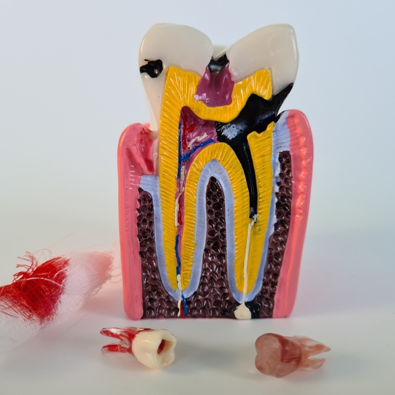 Soins_Dentaires_Noumea_Cabinet_Motorpool_Traitement_Caries