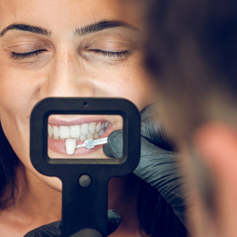 Esthetique_Dentaire_Facettes