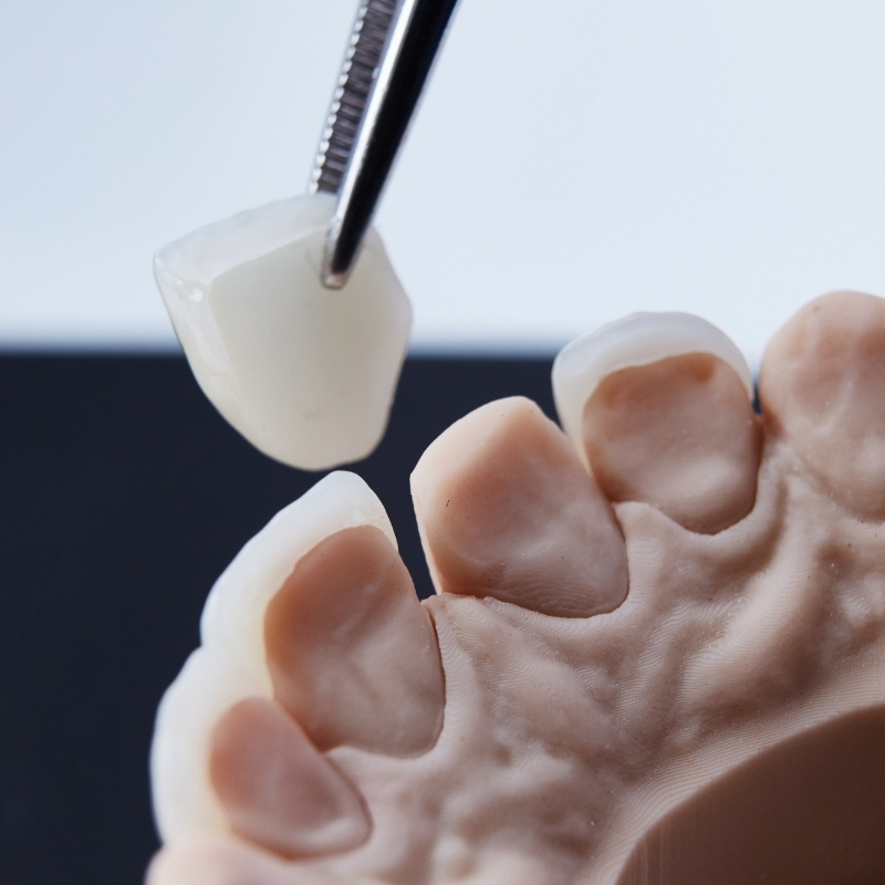 Prothese_Dentaire_Cabinet_Motorpool_Noumea_Dentiste_Facettes