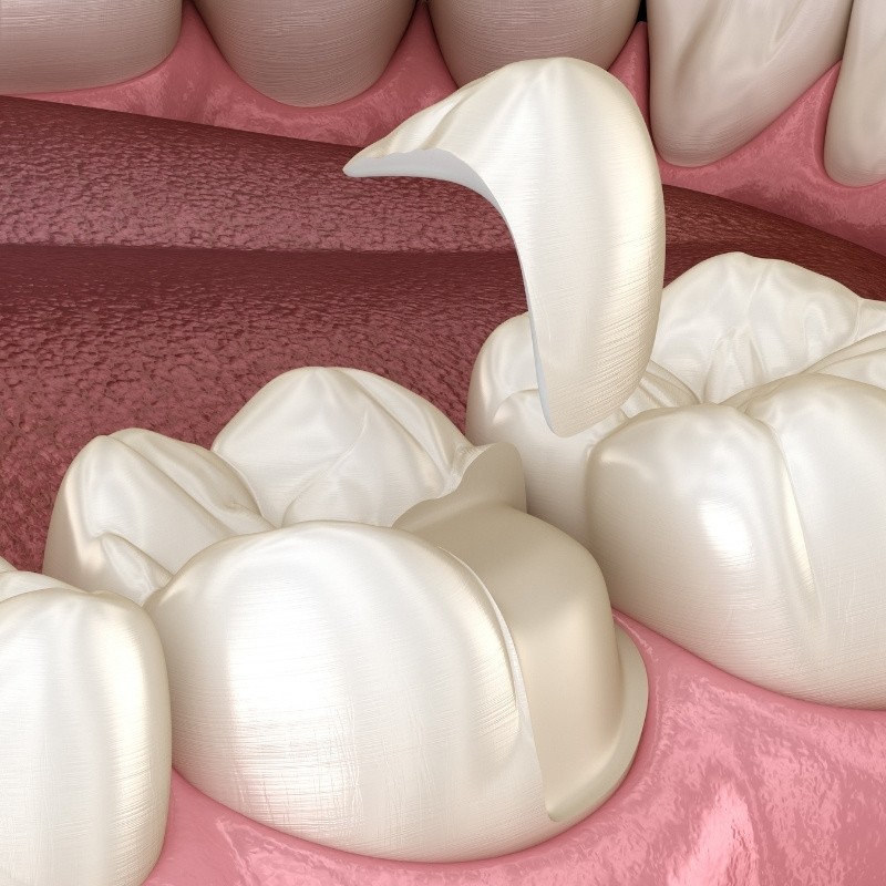 Prothese_Dentaire_Cabinet_Motorpool_Dentiste_Noumea_Inlays_Onlays_Overlays