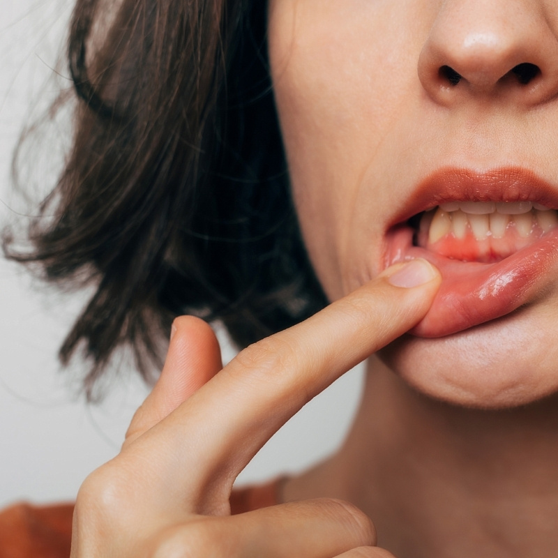 Saignement_des_gencives_Cabinet_Motorpool_Noumea